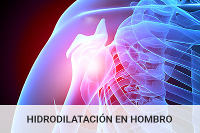 hidrodilatacion-hombro-c