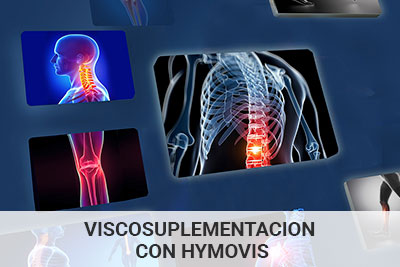 viscosuplementacion-hymovis-c