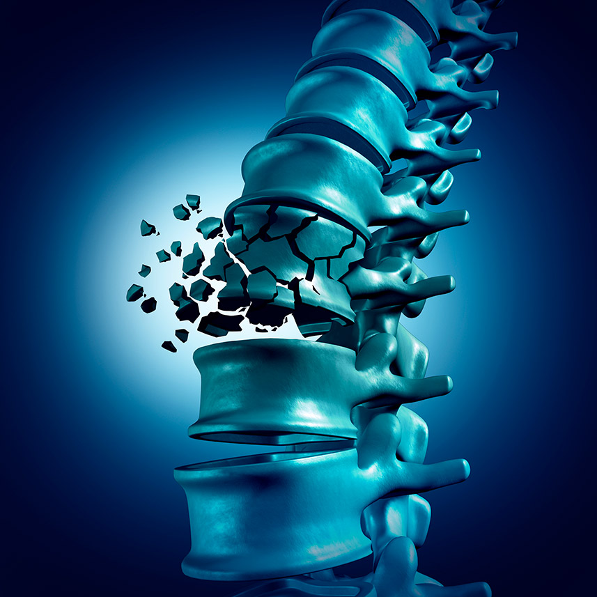 Osteoporosis - Clínica Luis Baños