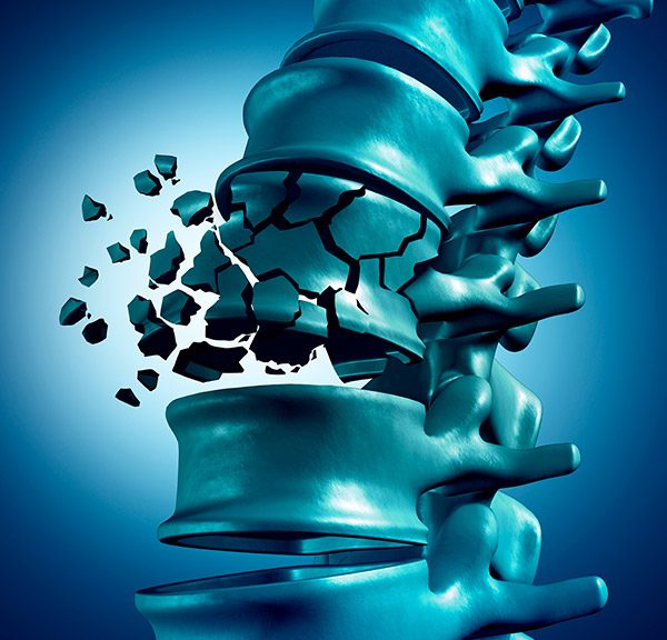 Osteoporosis - Clínica Luis Baños