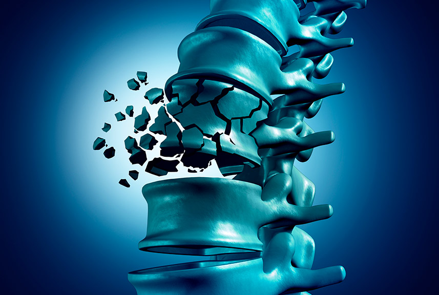 Osteoporosis - Clínica Luis Baños