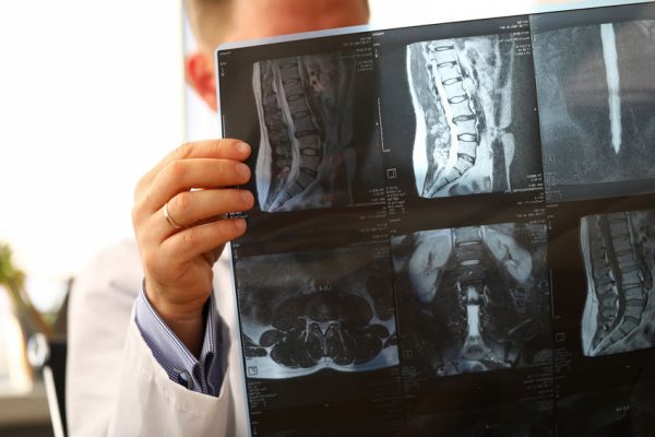 Doctor observando una radiografía de columna, detectando la existencia o no de una hernia de disco