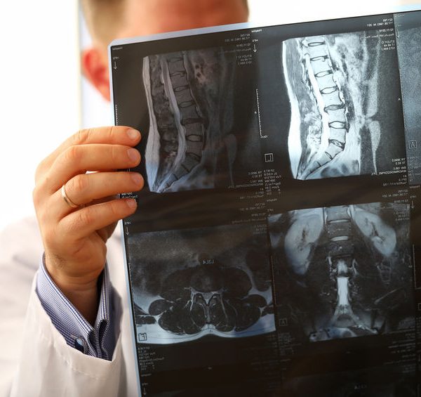 Doctor observando una radiografía de columna, detectando la existencia o no de una hernia de disco