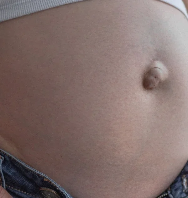 tipo de hernias en mujeres